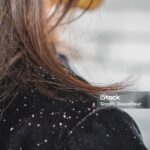 What Is Dandruff ?