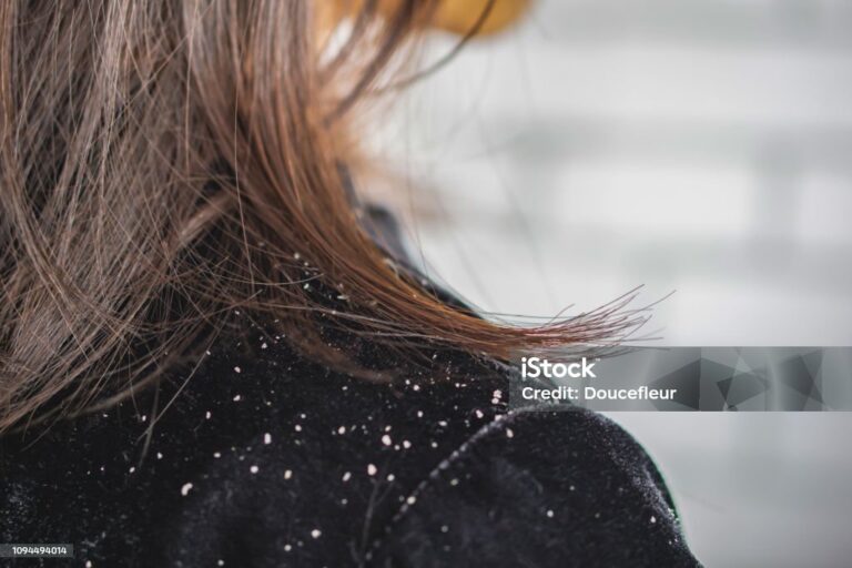 What is dandruff