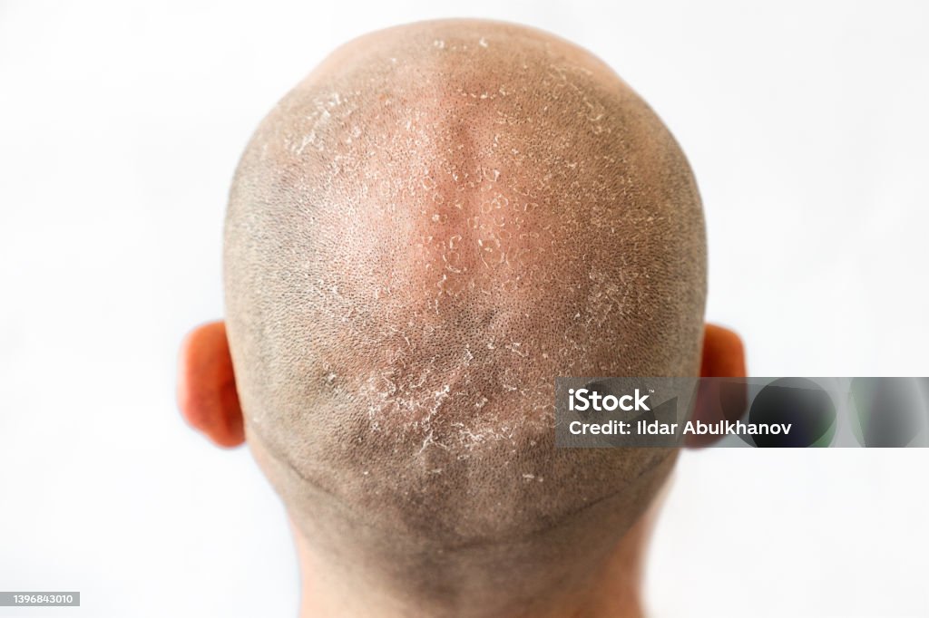 Read more about the article Is Dandruff Affected by Weather?
